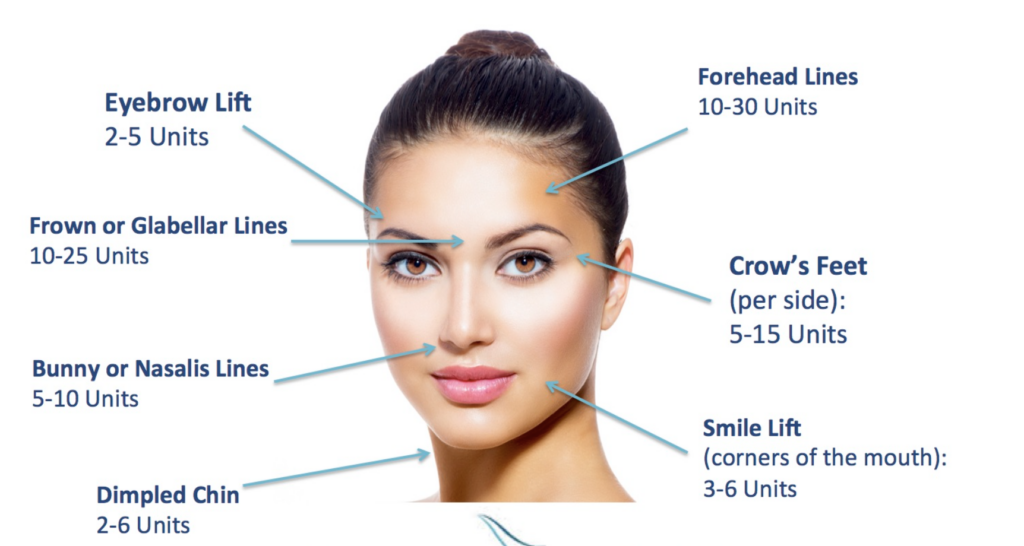 How much BOTOX will you need graphic showing a woman's face and the number of approximate units.